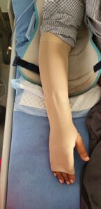 Bandaged arm